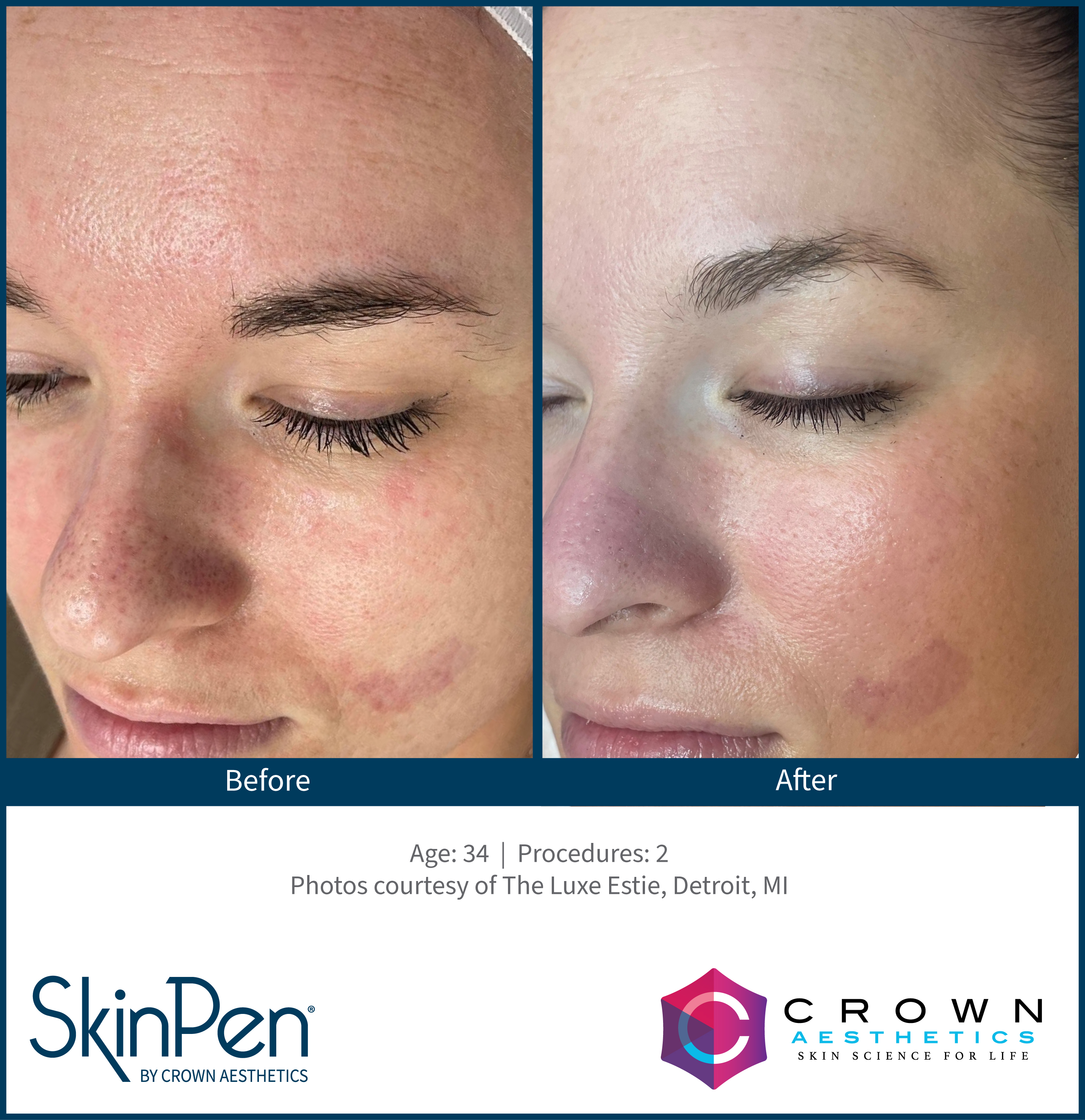SkinPen Vorher Nachher Hautbild
