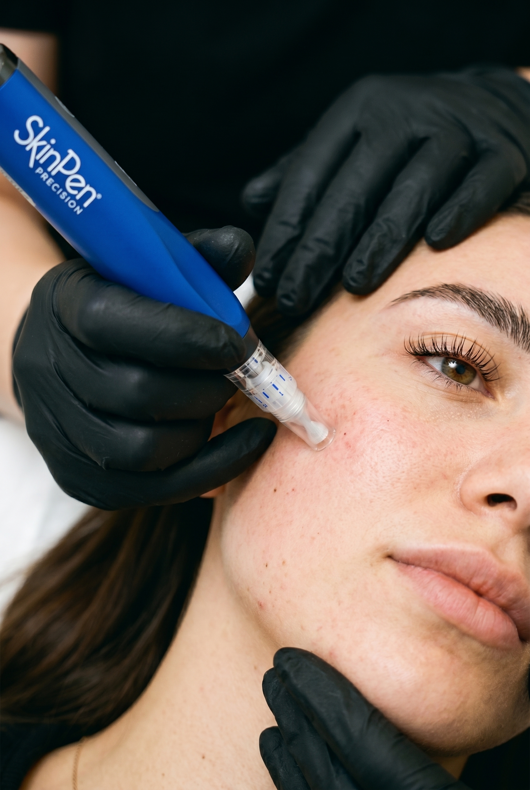 Microneedling-Behandlung mit dem SkinPen Precision bei Geestglanz