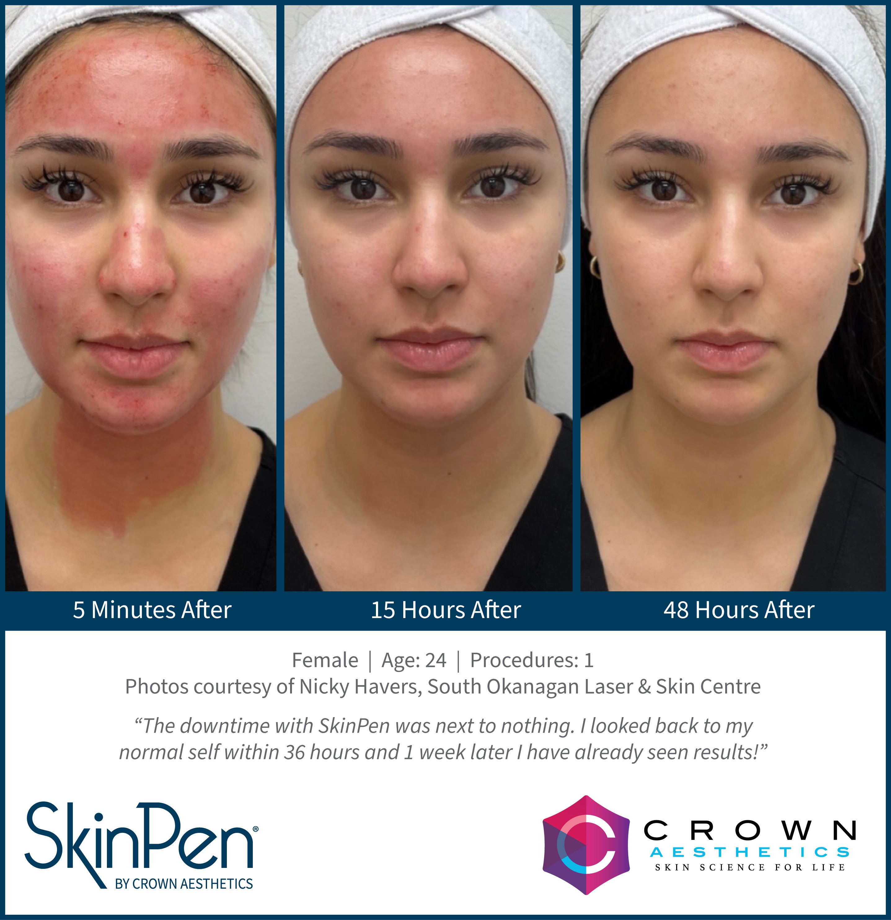 SkinPen Downtime Verlauf